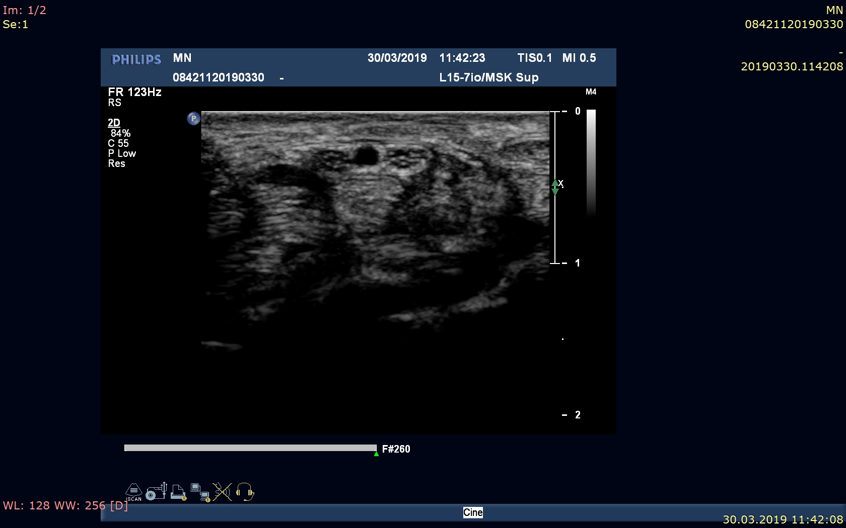 Obraz dwudzielnego nerwu pośrodkowego z tętnicą pośrodkową