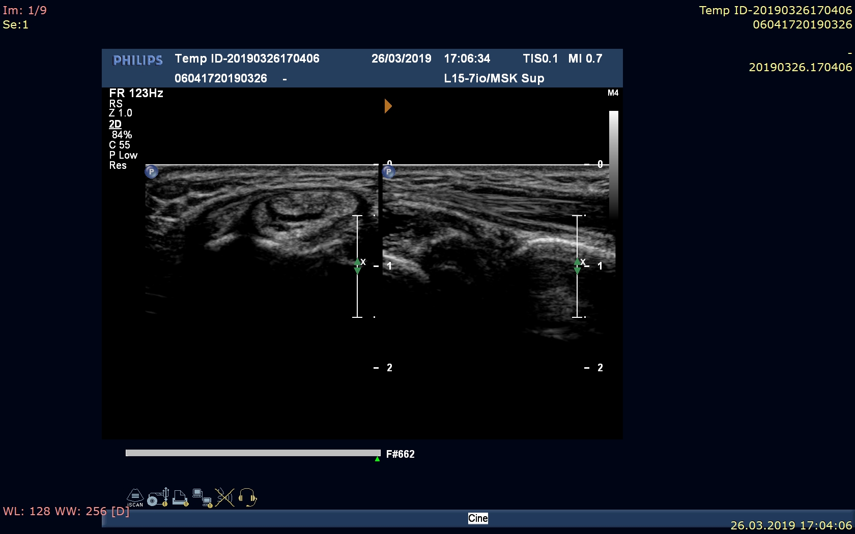 Nadgarstki - ból obustronny