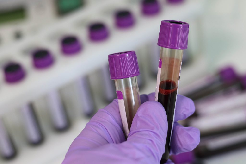 Analiza próbki krwi - wyniki usg tarczycy